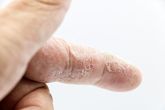 Calloused Hands: What That Rough Skin Really Means and How to Care for It