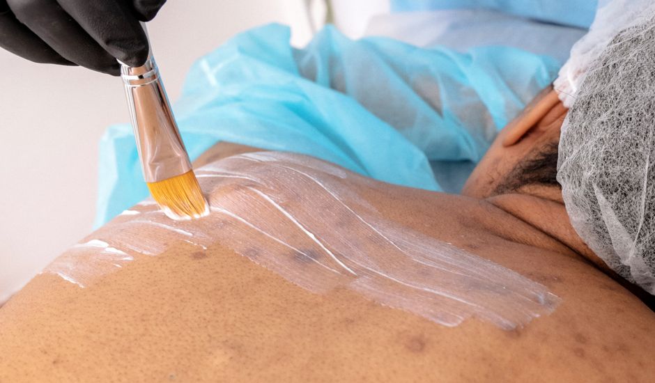 The Acne-Skin Barrier Connection: A Science-Backed System for Clear Skin