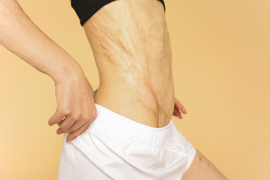 The Complete Guide to Stretch Mark Prevention for Men: Science-Backed Strategies for Maintaining Skin Resilience