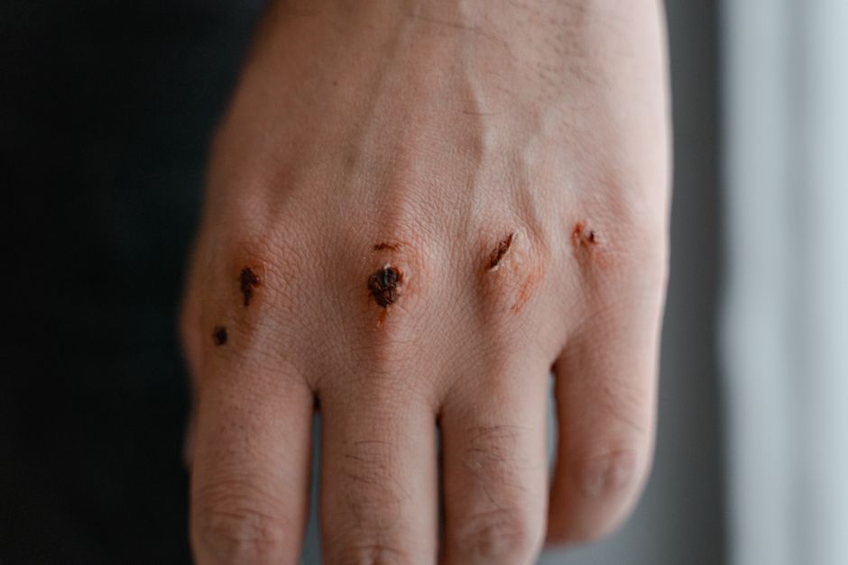 Minor Cuts and Scrapes: Why Comfort Care and Wound Care Are Not the Same Thing