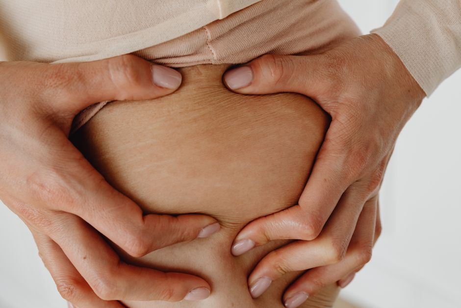 Choosing the Right Stretch Mark Prevention Strategy for Combination Skin