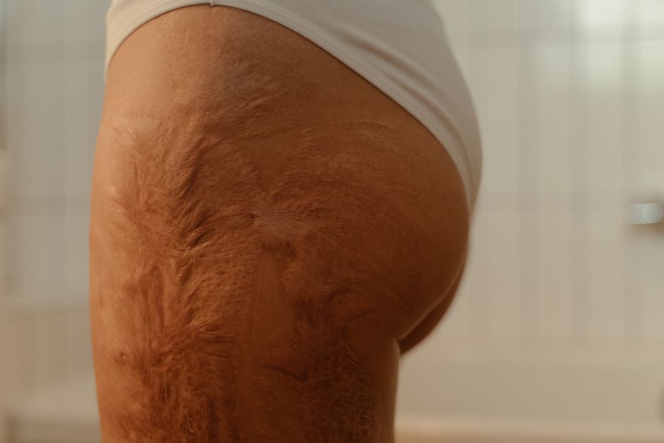 Cellulite Reduction for Combination Skin: A Realistic Guide to Smoother, Healthier-Looking Skin